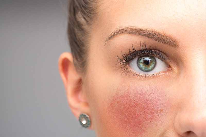 Rosacea